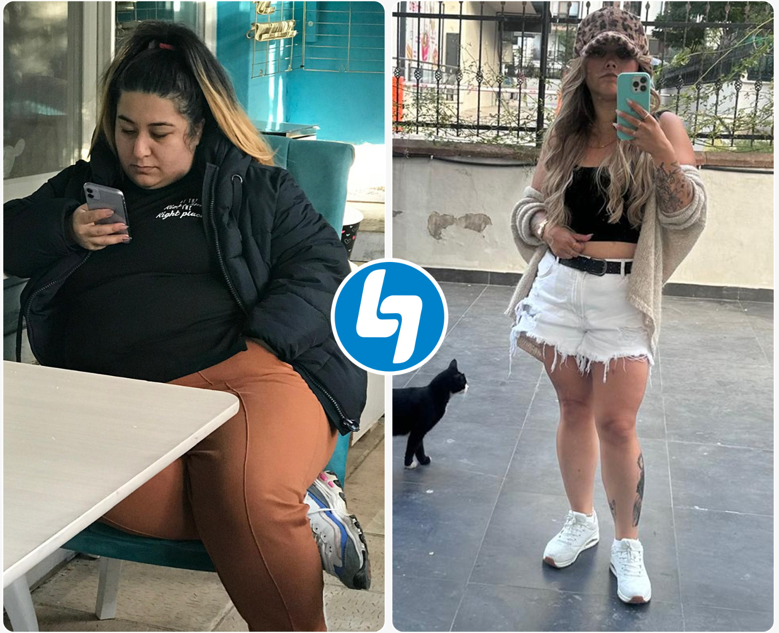 Gastric bypass surgery